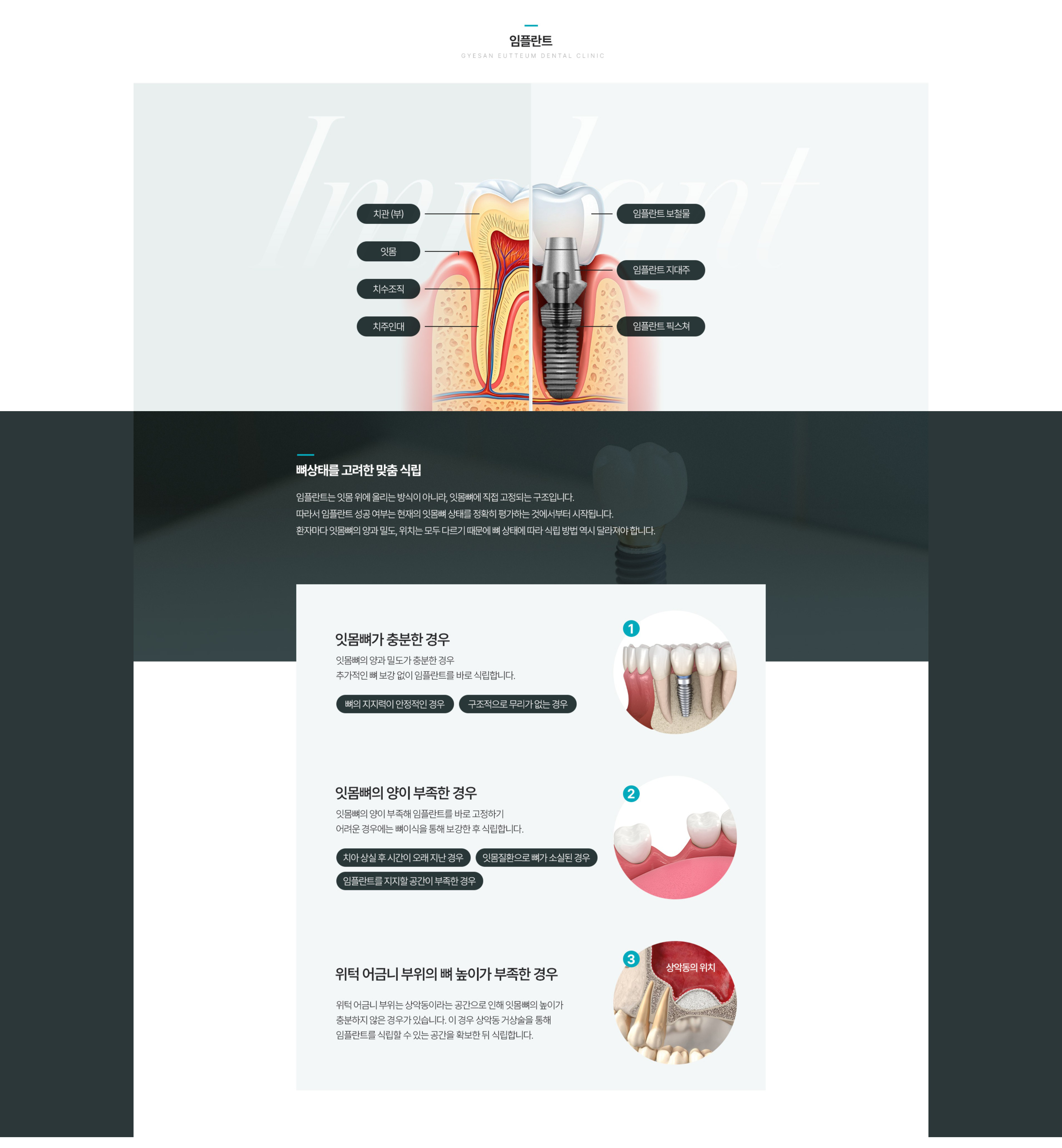 임플란트22.png